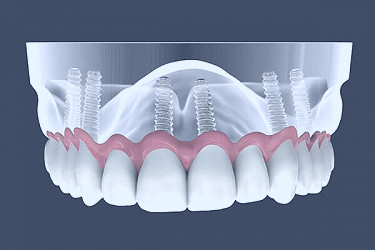 Dental Implants | Upper East Side NYC | Minoli & Vijay